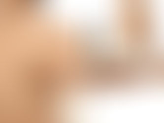 Arm Lift Brachioplasty in ANTALYA TURKEY