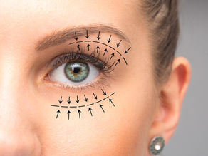 Lower and Upper Eyelid SurgeryBlepharoplasty in TURKEY ANTALYA