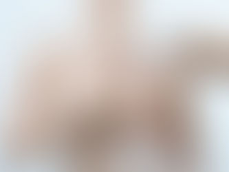 Breast Reduction Mammaplasty in TURKEY ANTALYA